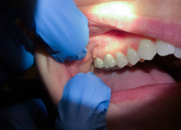 Best Emergency Dental Services for Seniors in Lifornia Polytechnic State University, CA