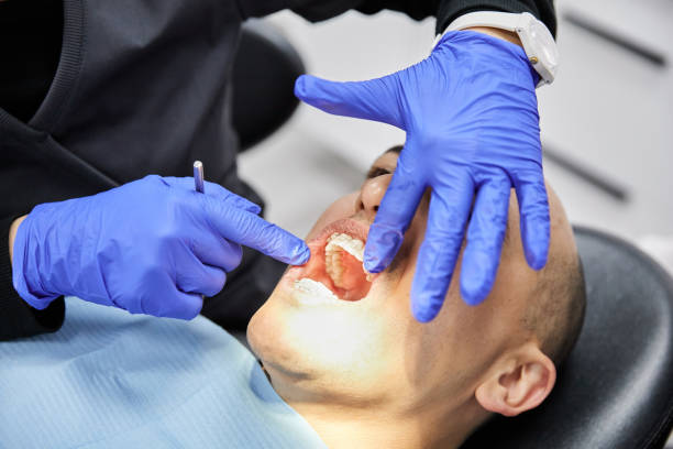 Best Emergency Dentist for Lost Fillings or Crowns in Lifornia Polytechnic State University, CA
